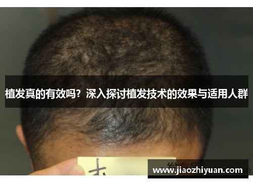 植发真的有效吗？深入探讨植发技术的效果与适用人群